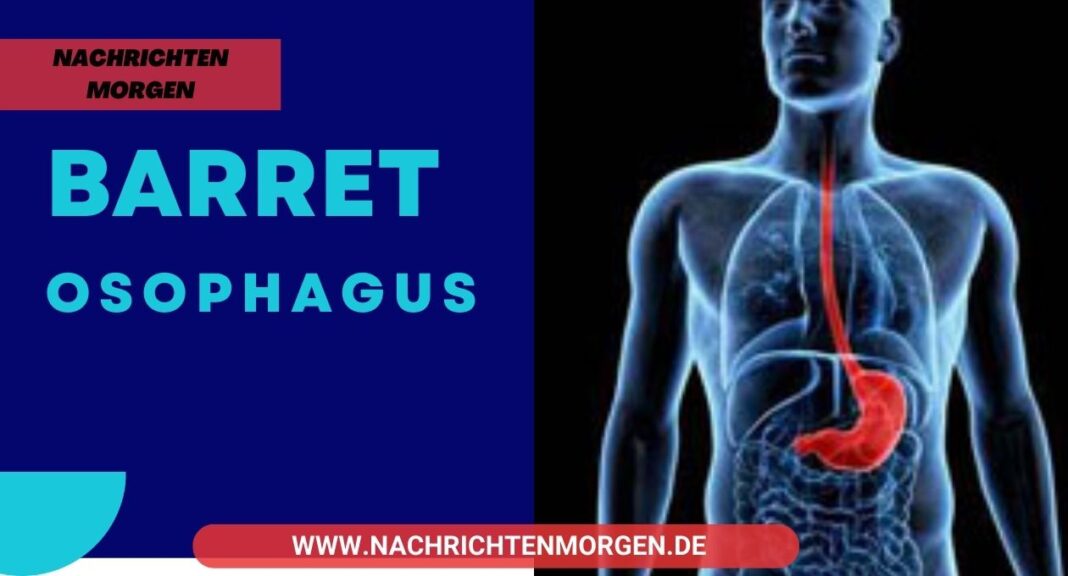 Barrett Ösophagus Symptome, Behandlung und Lebenserwartung