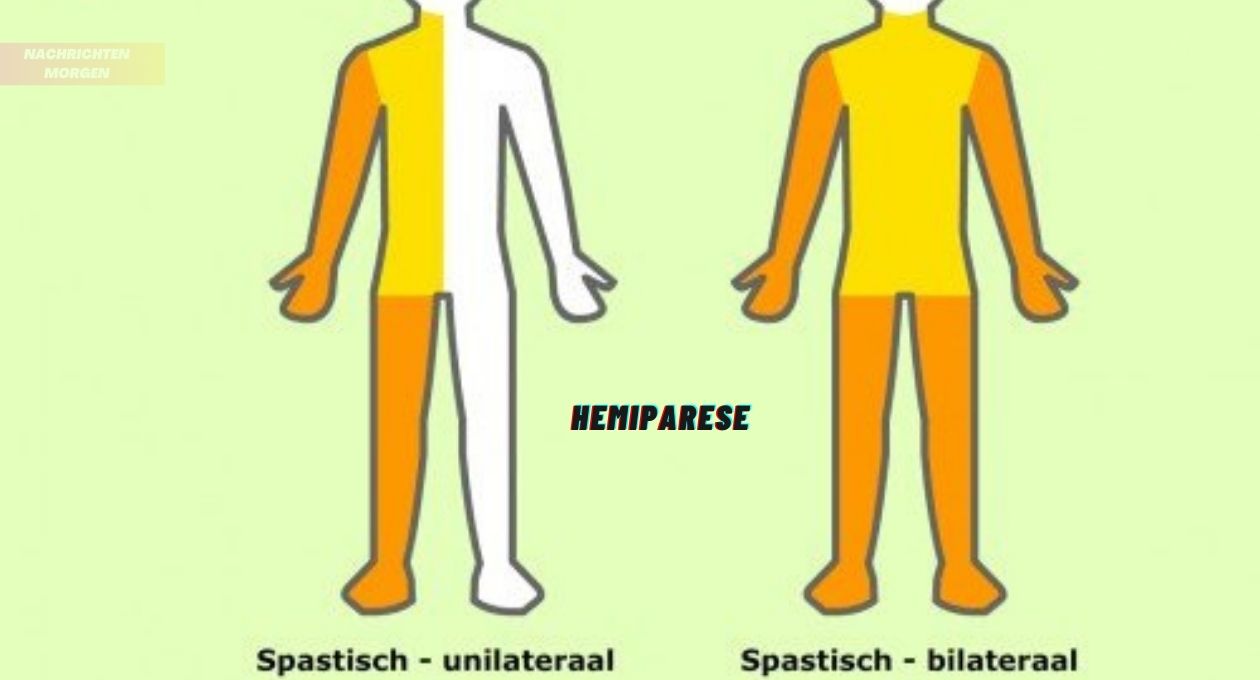 Hemiparese