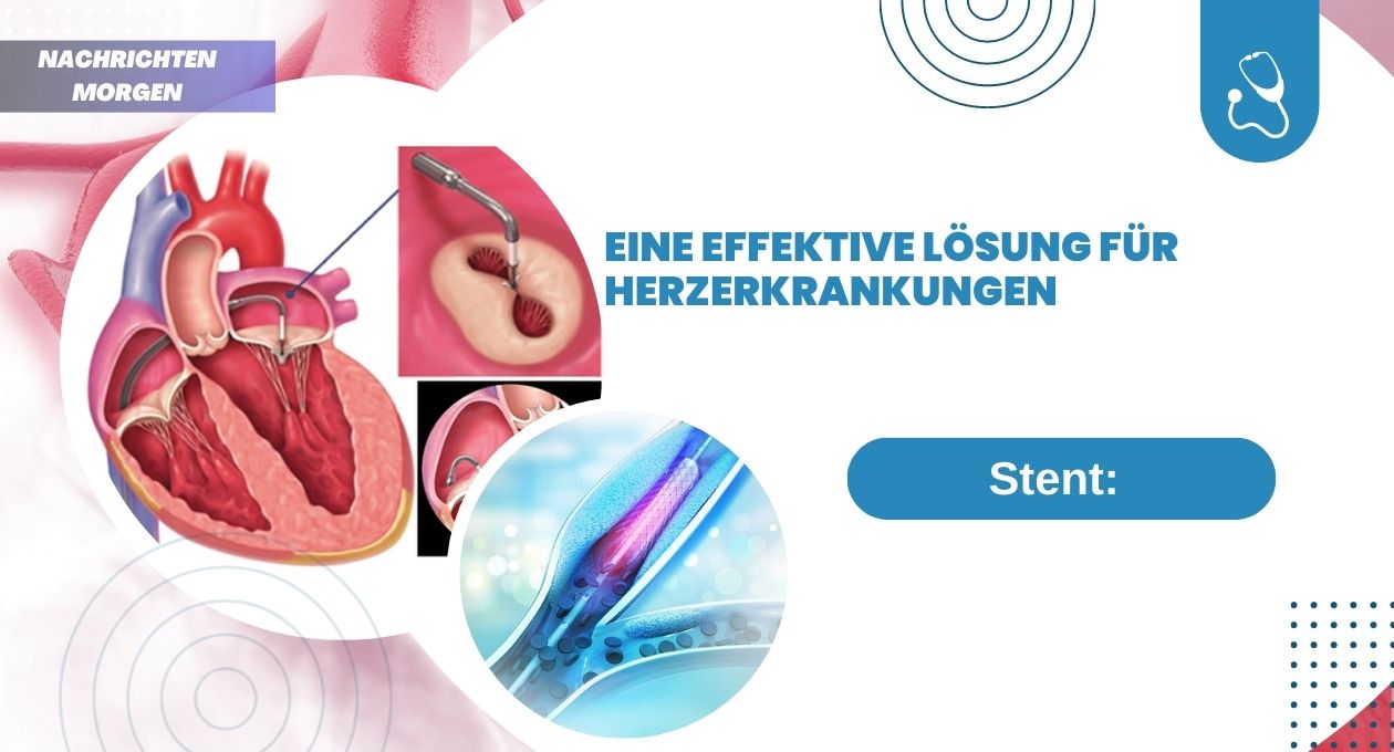 Stent Eine effektive Lösung für Herzerkrankungen