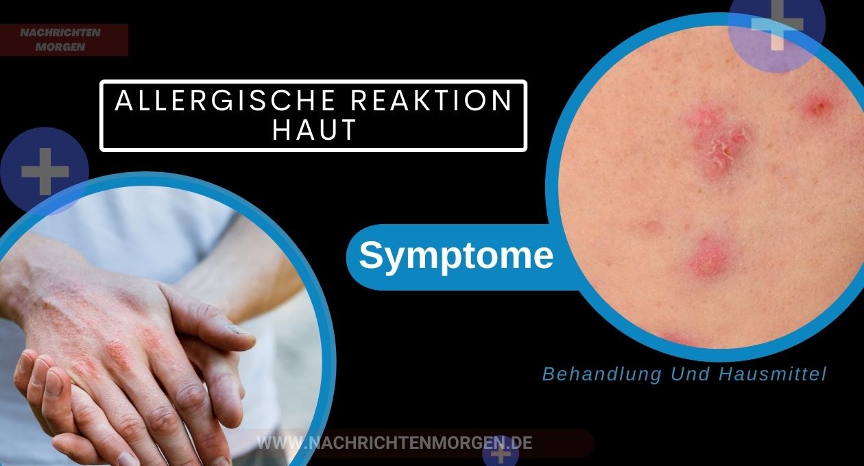 allergische reaktion haut