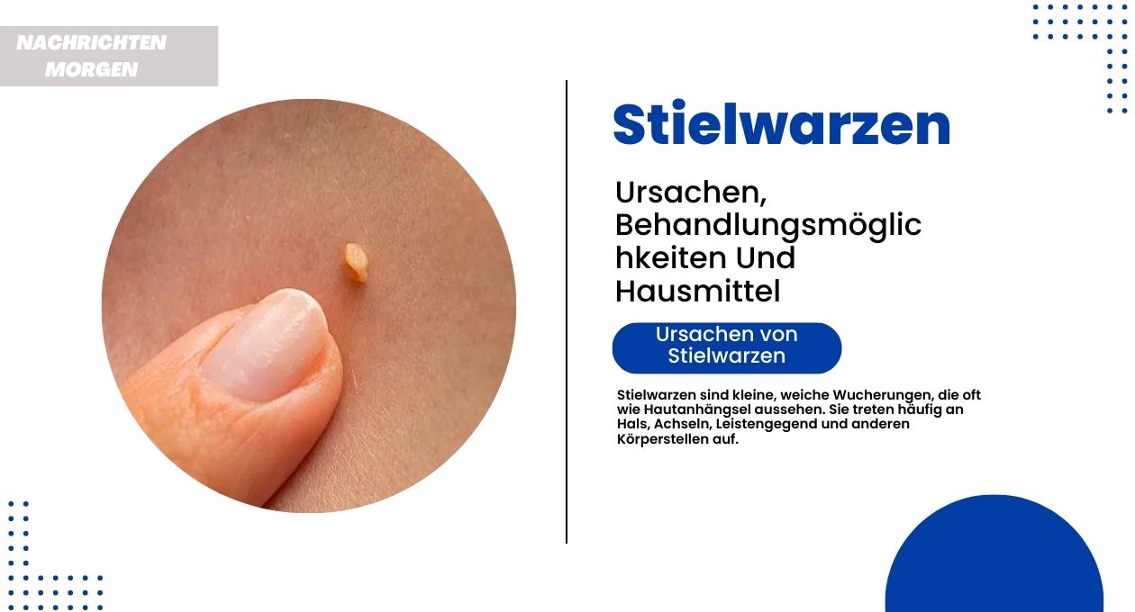 stielwarzen