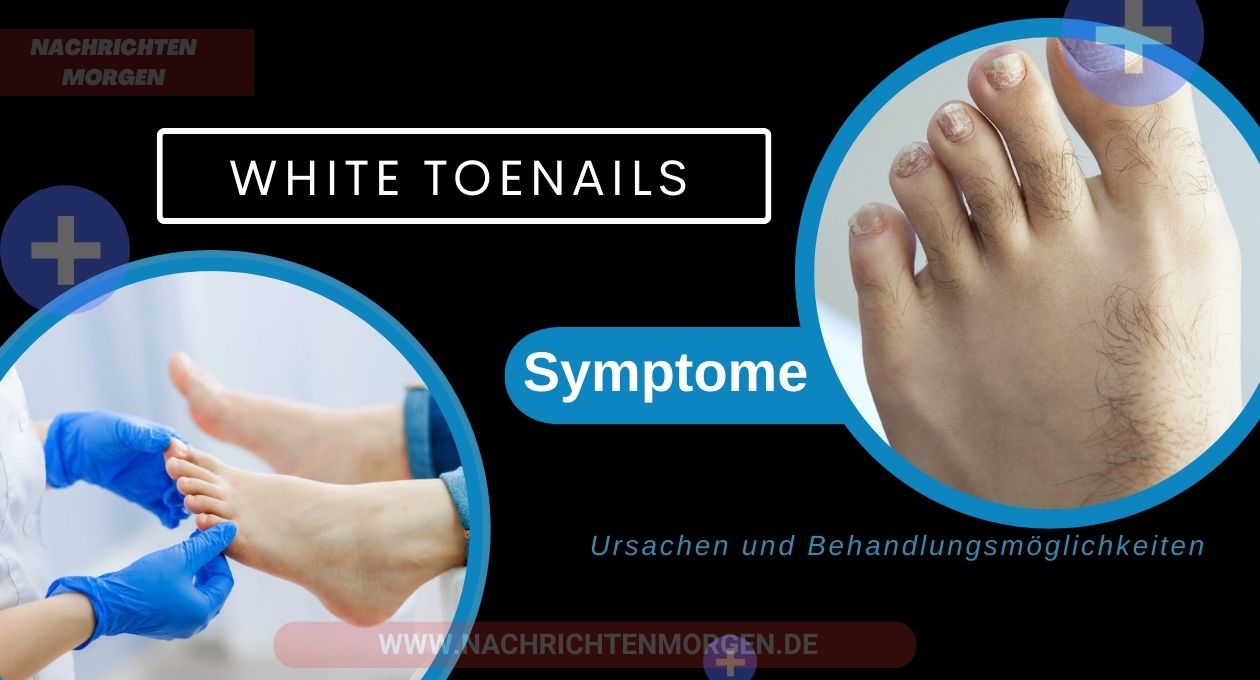 white toenails