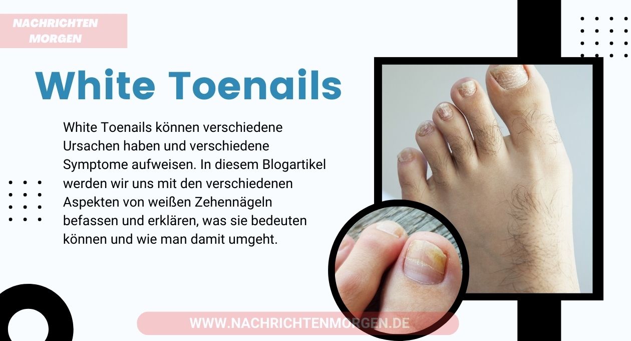 white toenails