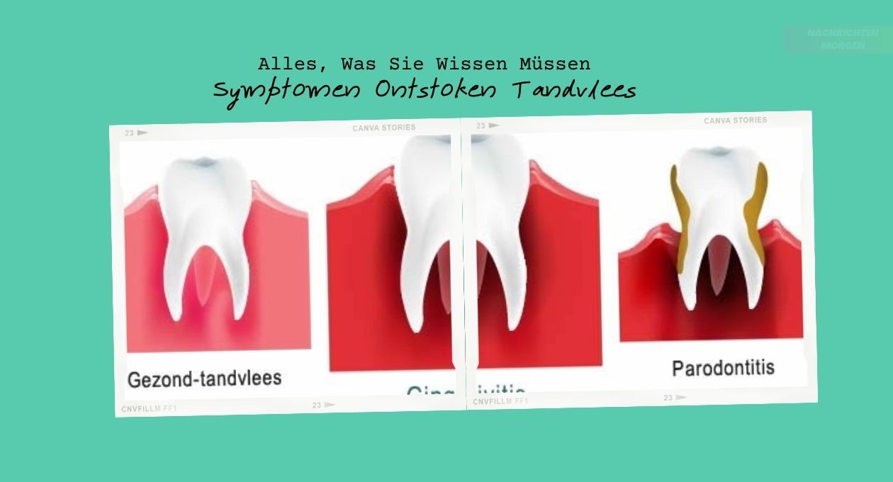 Symptomen Ontstoken Tandvlees