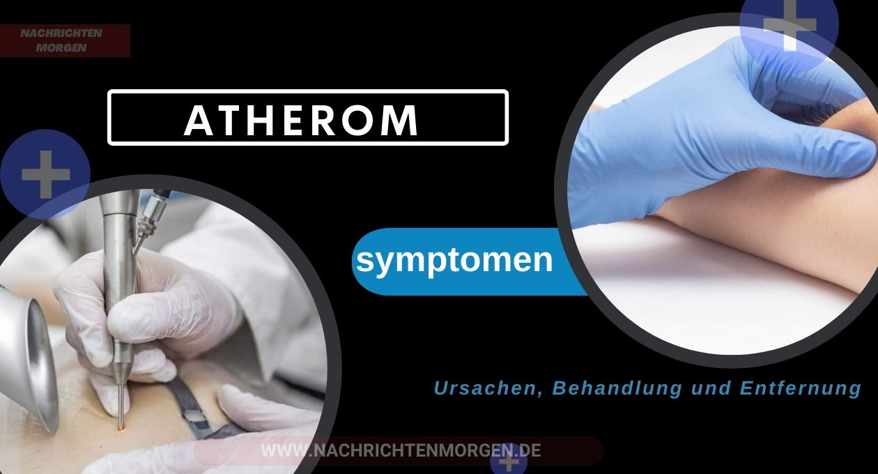 atherom