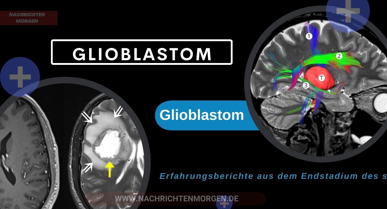 glioblastom