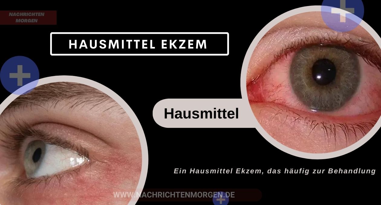 hausmittel ekzem