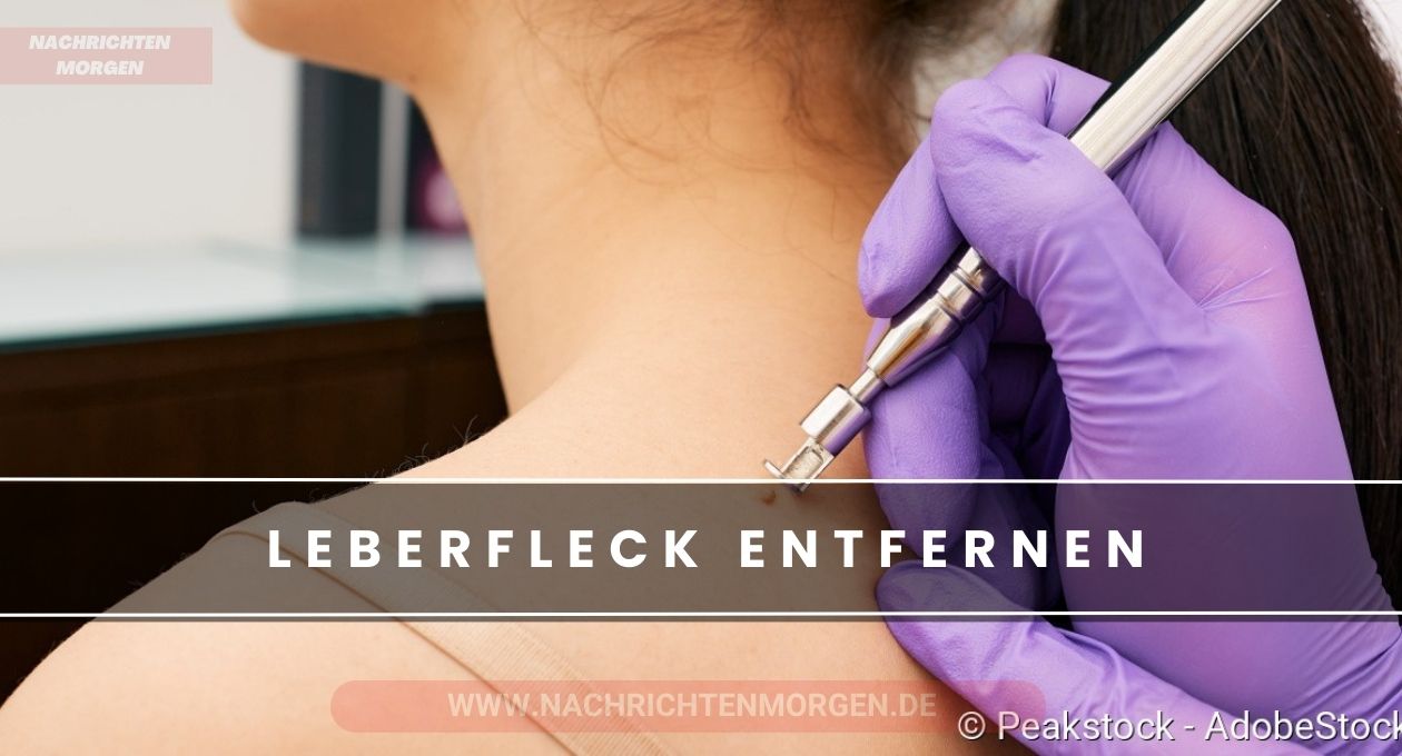 leberfleck entfernen