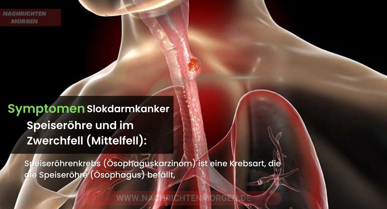 symptomen slokdarmkanker