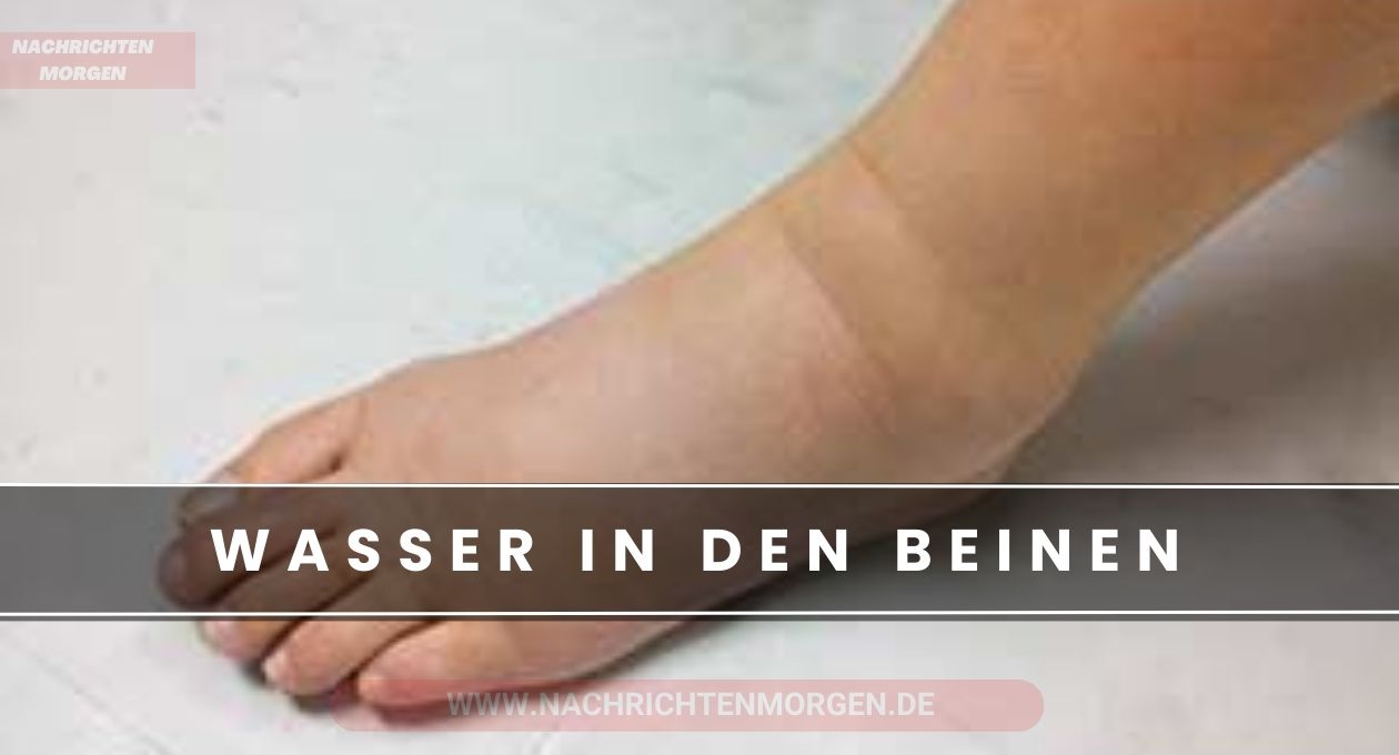 wasser in den beinen