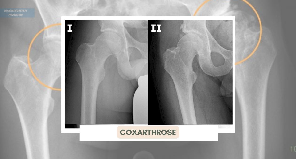 Coxarthrose