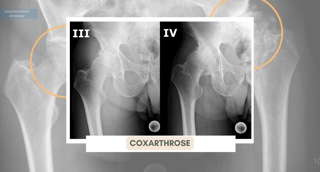 Coxarthrose