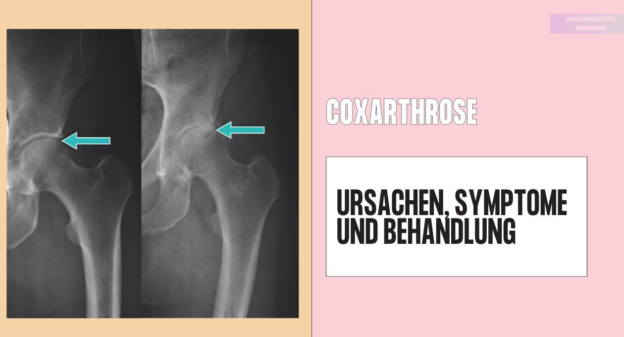 Coxarthrose