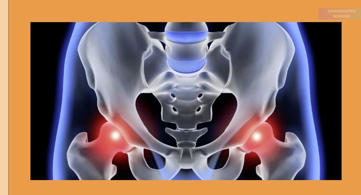 Coxarthrose