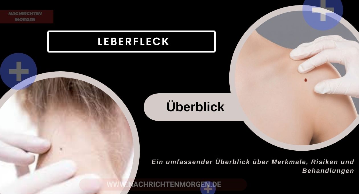 leberfleck