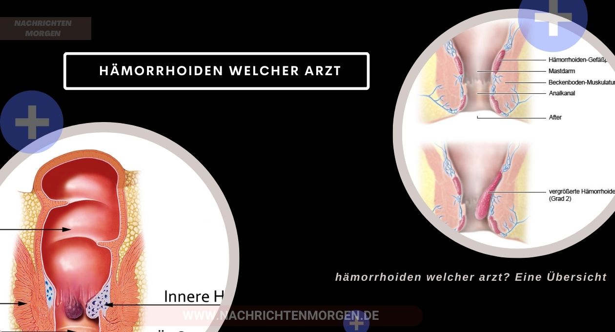 hämorrhoiden welcher arzt