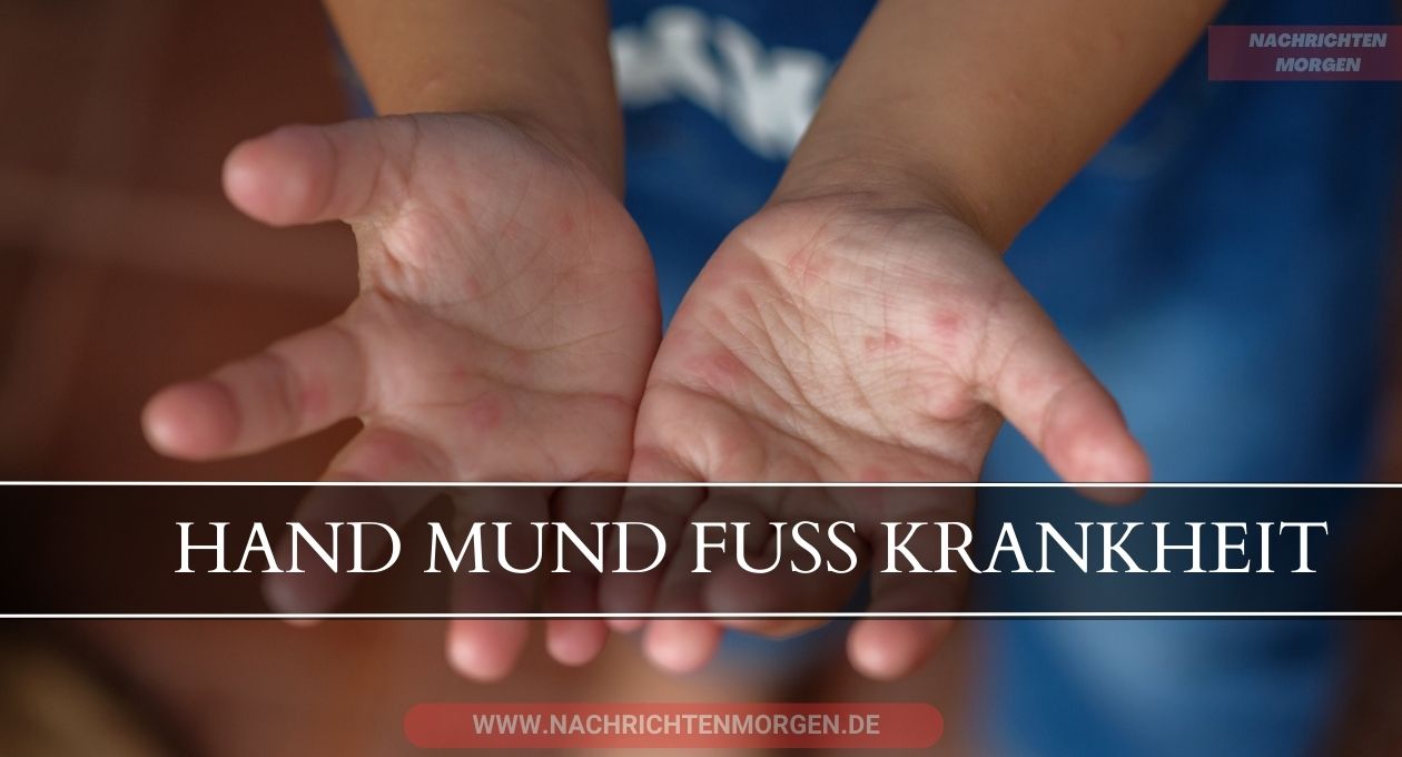 hand mund fuß krankheit a