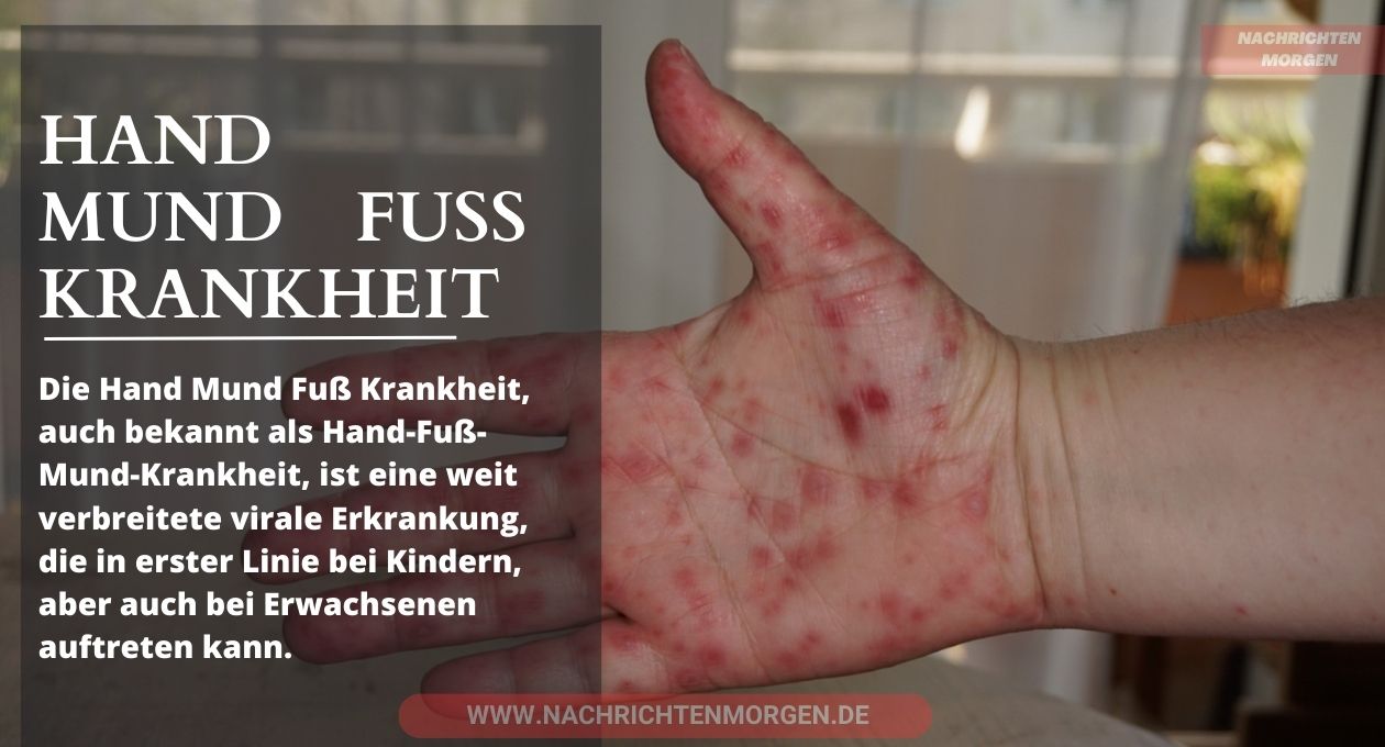 hand mund fuß krankheit a