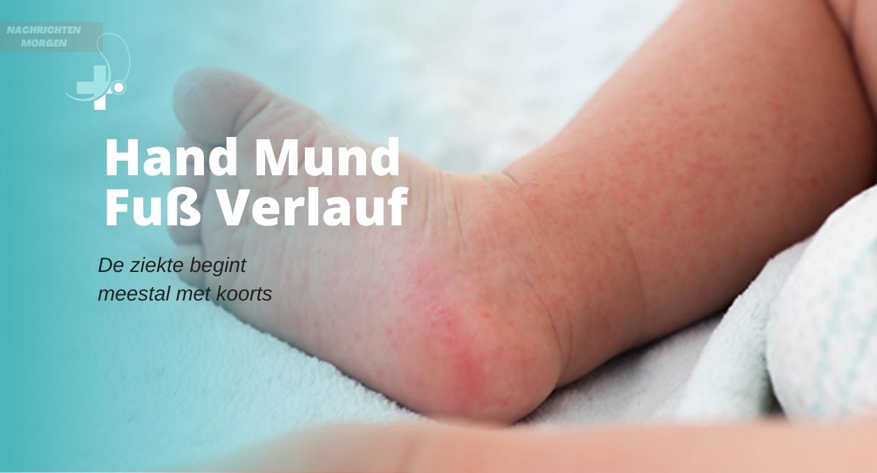 hand mund fuß verlauf