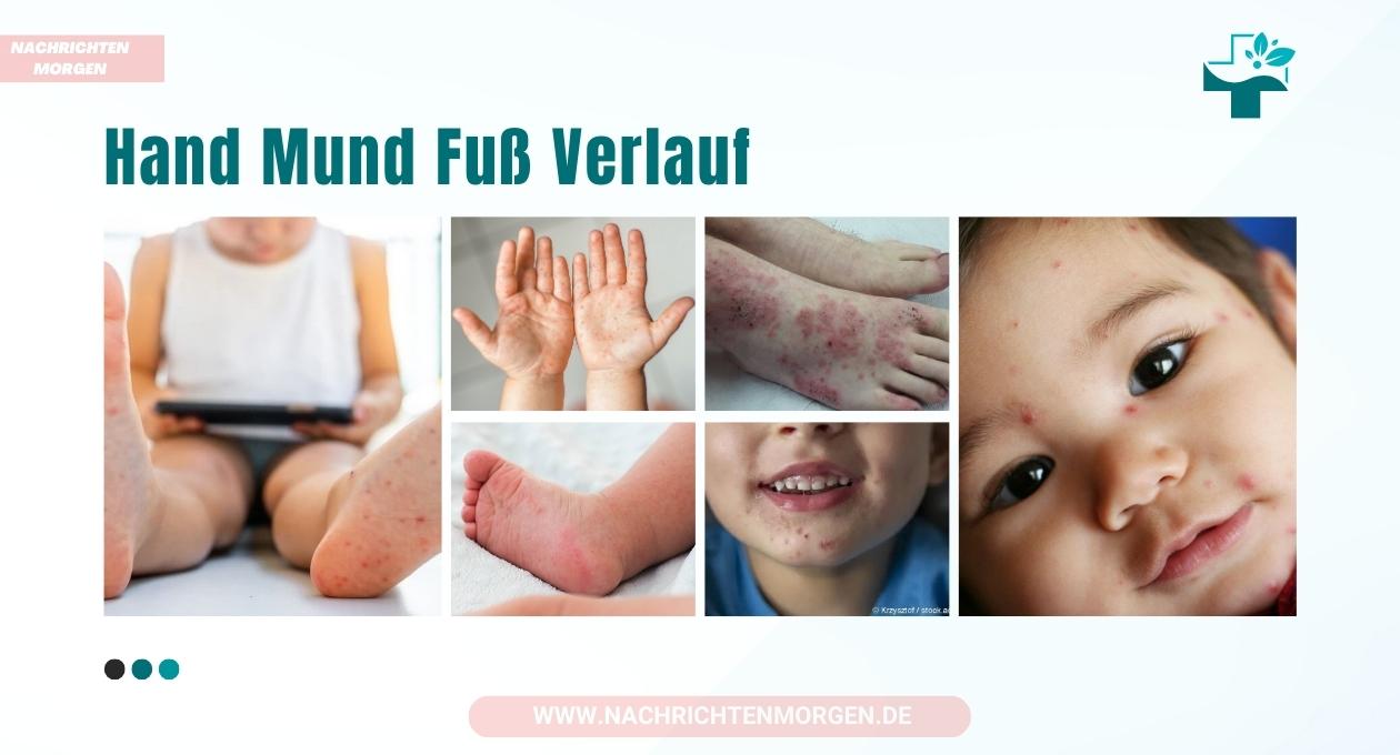 hand mund fuß verlauf